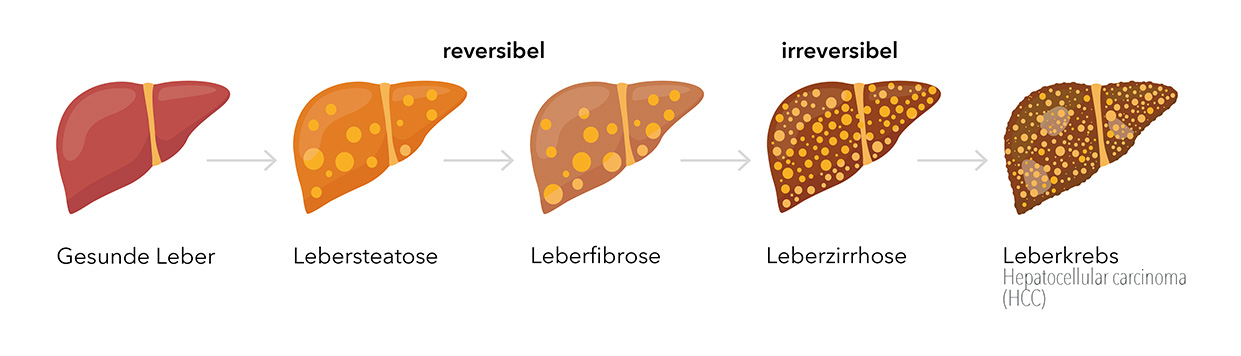 Fortschreiten der Leberschädigung