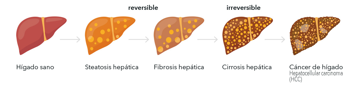 Progresión de la lesión hepática