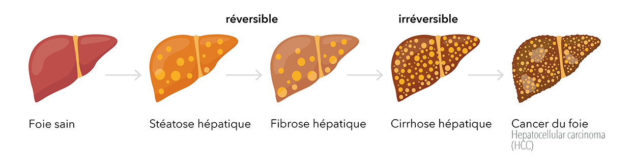 Progression des lésions hépatiques